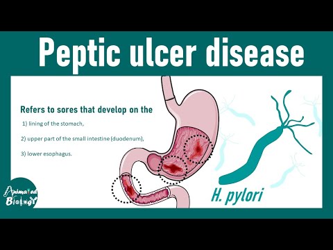 Peptic ulcer disease | Cause of gastric and duodenal ulcers | USMLE step 1