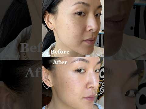 BBL laser therapy + Microneedling healing progress before & after