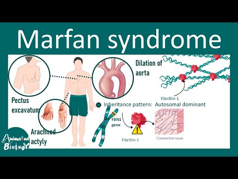 Marfan Syndrome | Pathophysiology, Diagnosis, Management | USMLE STEP1