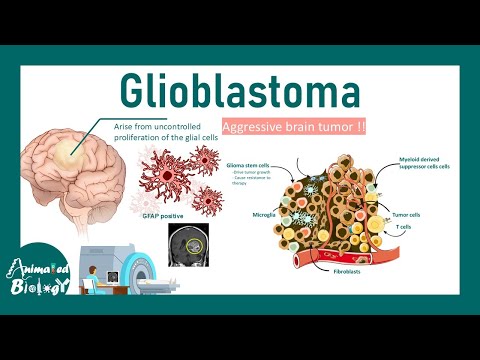 Glioblastoma | Cause of Glioblastoma | Molecular subtypes of glioblastoma | Treatment